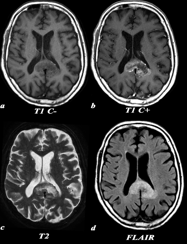 Corpus Callosum | Brain